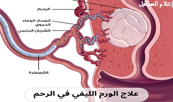 علاج الورم الليفي في الرحم من الأدوية إلى الجراحة