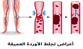 اعراض تجلط الأوردة العميقة: تهديد صامت وكيفية اكتشافه مبكرًا