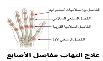 كل ما تحتاج معرفته عن علاج التهاب مفاصل الاصابع