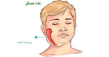 النكاف: الاسباب-الأعراض-الوقاية و طرق العلاج