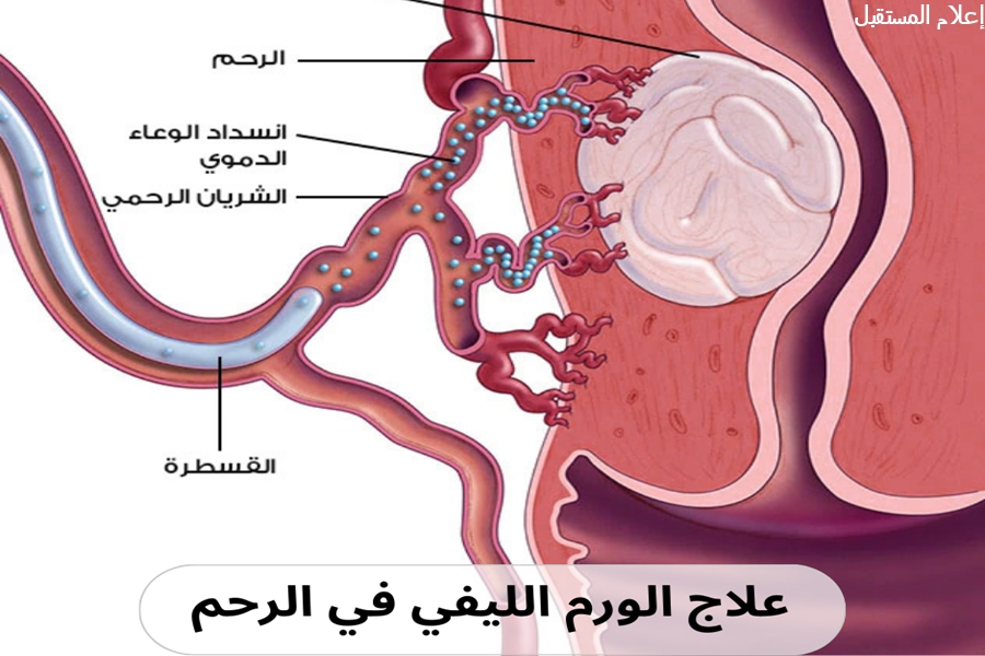 علاج الورم الليفي في الرحم من الأدوية إلى الجراحة