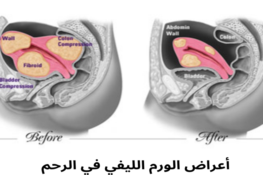 أسباب وعلامات الورم الليفي في الرحم