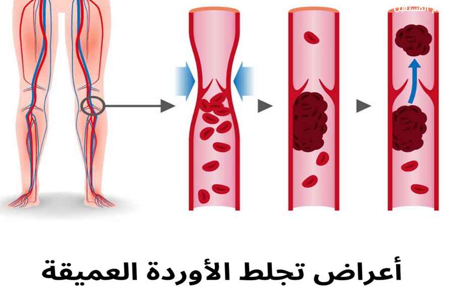 اعراض تجلط الأوردة العميقة: تهديد صامت وكيفية اكتشافه مبكرًا