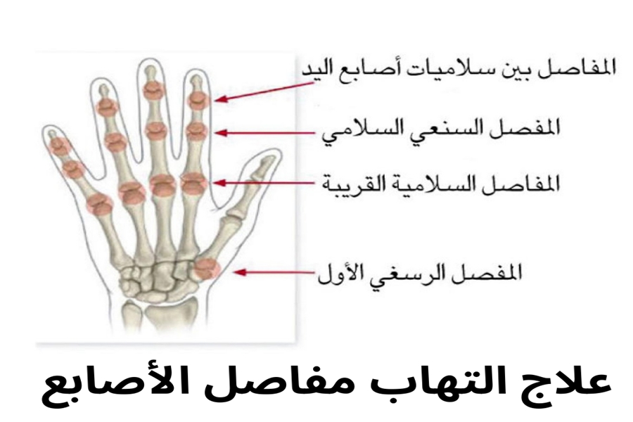 كل ما تحتاج معرفته عن علاج التهاب مفاصل الاصابع