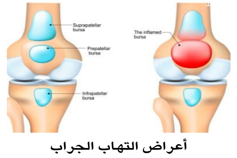 ما هو التهاب الجراب؟ تعرف على أنواعه وكيفية الوقاية منه