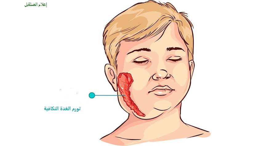 النكاف: الاسباب-الأعراض-الوقاية و طرق العلاج