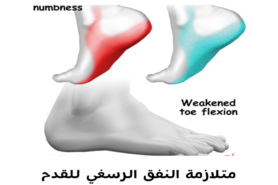 متلازمة النفق الرسغي للقدم: الأسباب والأعراض والعلاج