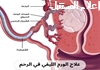 علاج الورم الليفي في الرحم من الأدوية إلى الجراحة